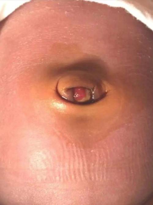 新生儿15天脐带出血是正常现象还是异常情况？需要立即就医处理吗？-第3张图片-郑州医学网