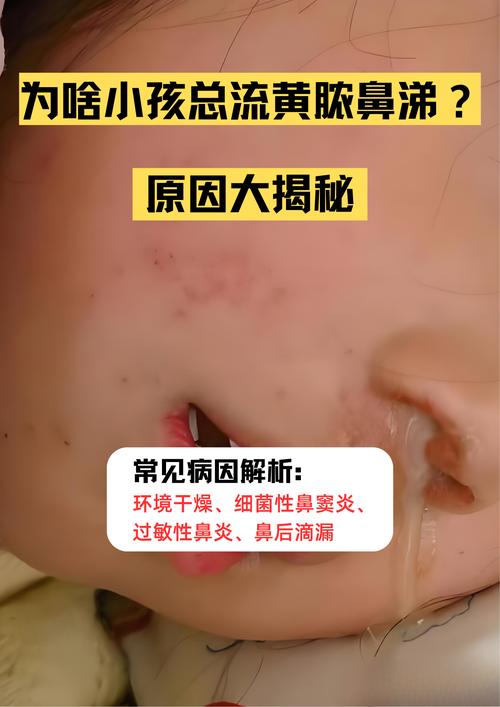 新生儿鼻子里有黄鼻涕-第1张图片-郑州医学网