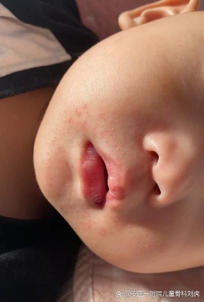 新生儿嘴唇颜色偏红紫是缺氧还是正常生理现象？需警惕哪些潜在问题？-第3张图片-郑州医学网