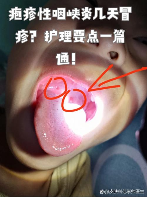 儿童咽喉疱疹高烧不退怎么办？最佳治疗方法与护理指南-第2张图片-郑州医学网