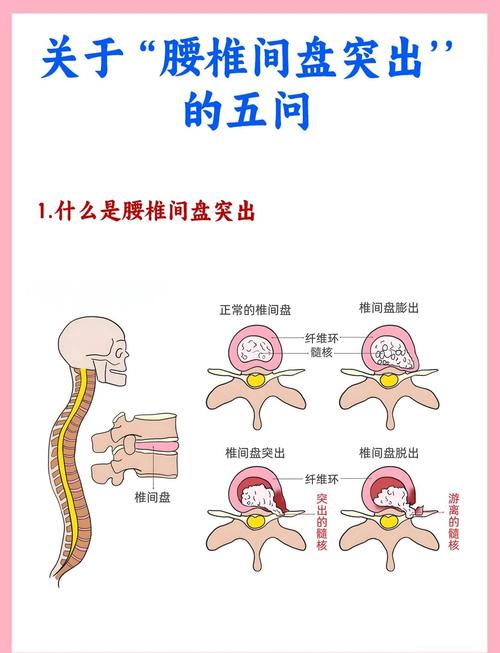 怀孕期间腰椎间盘突出，该如何缓解疼痛并保障母婴健康？-第1张图片-郑州医学网