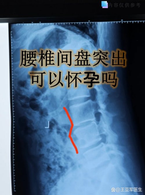 怀孕期间腰椎间盘突出，该如何缓解疼痛并保障母婴健康？-第2张图片-郑州医学网