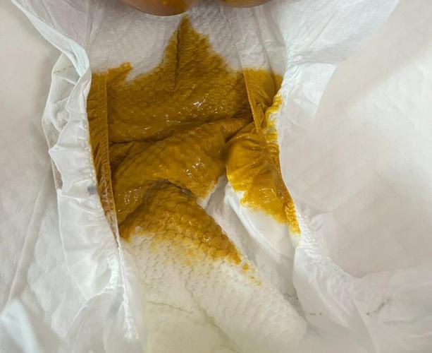 新生儿粑粑酸臭是正常现象吗？需要调整喂养方式吗？-第2张图片-郑州医学网