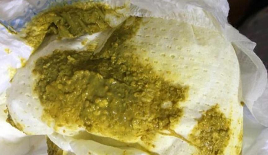 新生儿粑粑酸臭是正常现象吗？需要调整喂养方式吗？-第3张图片-郑州医学网