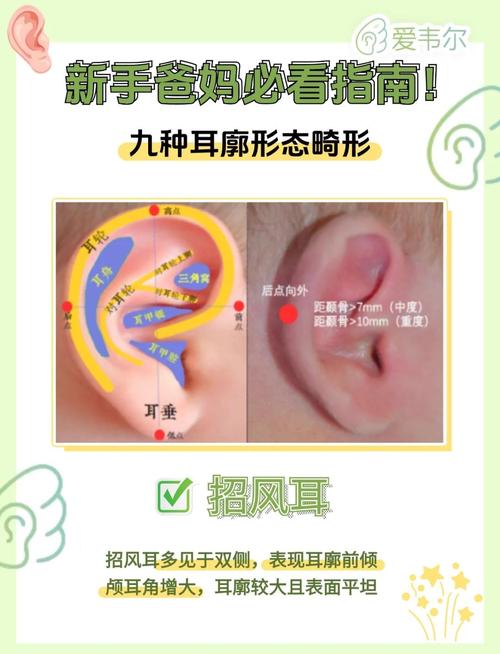 新生儿垂耳能自行恢复吗？家长该如何科学判断与干预？-第1张图片-郑州医学网