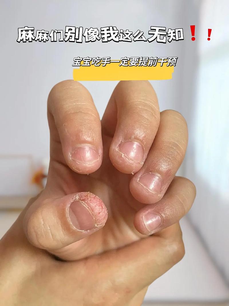 儿童咬指甲是什么原因-第1张图片-郑州医学网