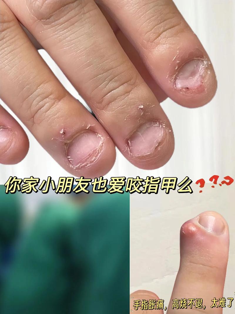 儿童咬指甲是什么原因-第2张图片-郑州医学网