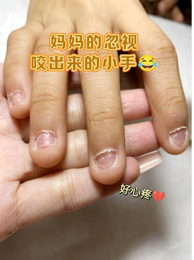 儿童咬指甲是什么原因-第3张图片-郑州医学网