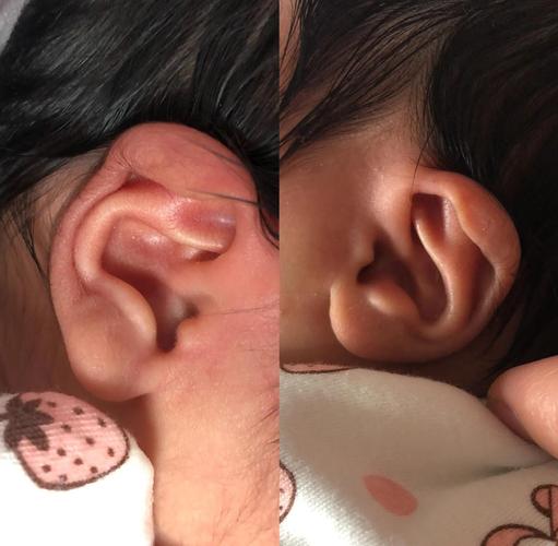 新生儿耳朵旁长福耳是福兆还是异常？需要关注哪些健康问题？-第3张图片-郑州医学网