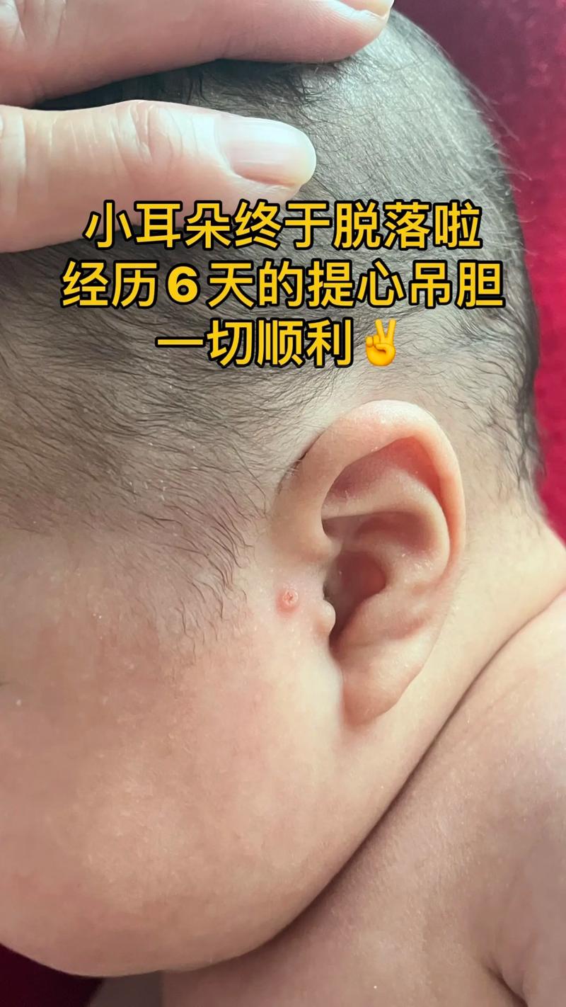 新生儿耳朵旁长福耳是福兆还是异常？需要关注哪些健康问题？-第2张图片-郑州医学网
