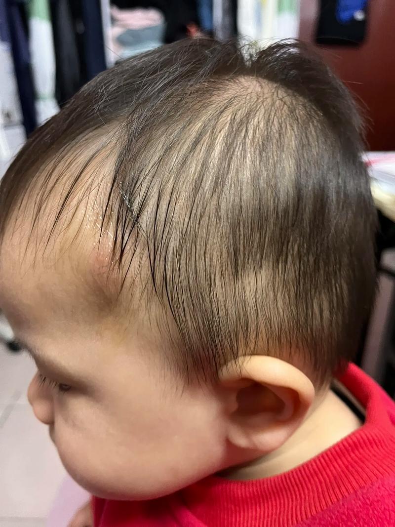 新生儿出生后头发掉得厉害,是正常生理现象还是健康预警?需警惕哪些潜在问题?-第3张图片-郑州医学网 新生儿出生后头发掉得厉害,是正常生理现象还是健康预警?需警惕哪些潜在问题?-第3张图片-郑州医学网