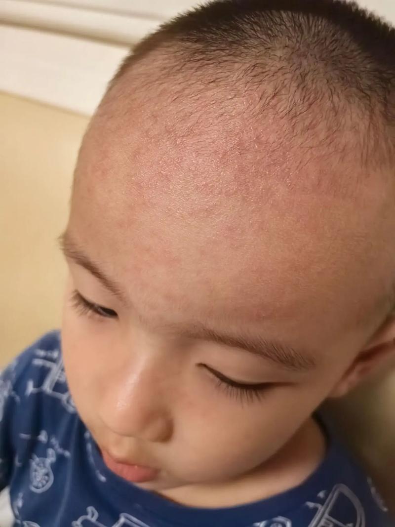 新生儿额头不烫身上烫是正常现象还是生病信号？体温异常该如何判断处理？-第1张图片-郑州医学网