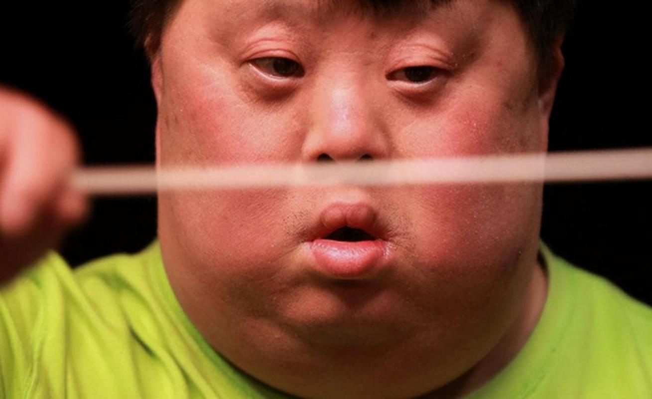 新生儿唐氏症状图片具体有哪些典型特征？如何通过图片初步识别？-第2张图片-郑州医学网