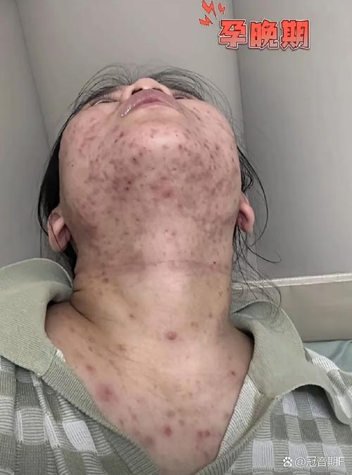 孕期满脸长痘是激素变化导致，还是皮肤护理出了问题？-第3张图片-郑州医学网