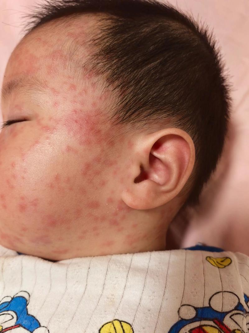 儿童病毒细菌混合感染为何高发?症状与单纯感染有何不同?如何精准识别与科学应对?-第1张图片-郑州医学网 儿童病毒细菌混合感染为何高发?症状与单纯感染有何不同?如何精准识别与科学应对?-第1张图片-郑州医学网