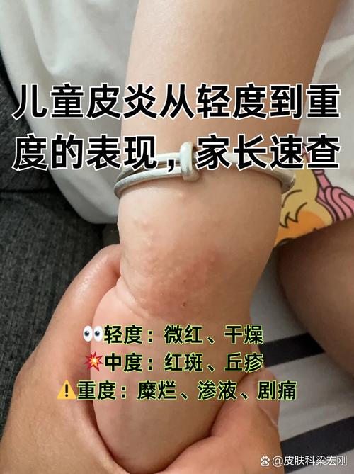 儿童病毒细菌混合感染为何高发?症状与单纯感染有何不同?如何精准识别与科学应对?-第2张图片-郑州医学网 儿童病毒细菌混合感染为何高发?症状与单纯感染有何不同?如何精准识别与科学应对?-第2张图片-郑州医学网