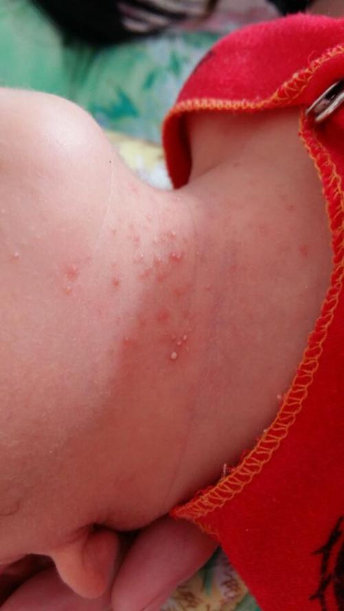 新生儿肚子长红色点点是正常现象还是疾病信号？需警惕哪些潜在风险？-第2张图片-郑州医学网