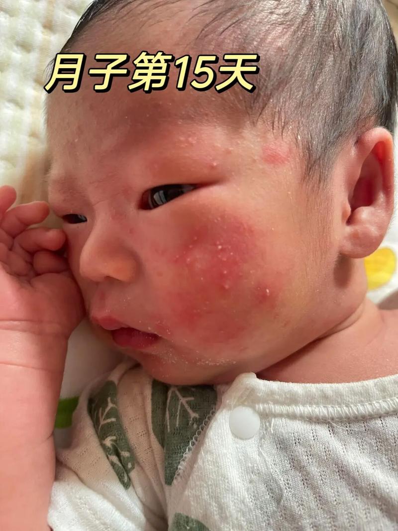 新生儿肚子长红色点点是正常现象还是疾病信号？需警惕哪些潜在风险？-第1张图片-郑州医学网