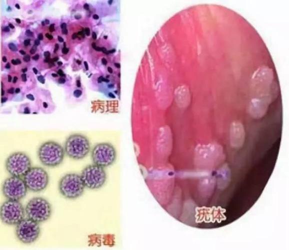 孕期外阴莫名长肉疙瘩是何原因？需要担心吗？对胎儿有影响吗？-第1张图片-郑州医学网