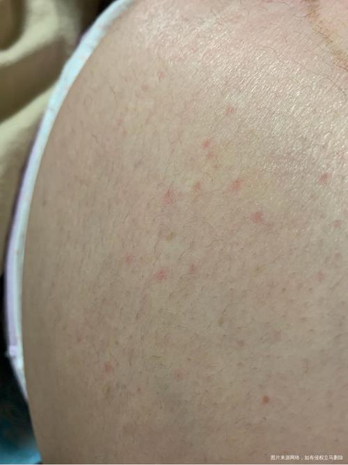 怀孕期间肚皮痒且有红点,是皮肤问题还是妊娠特殊反应?-第2张图片-郑州医学网 怀孕期间肚皮痒且有红点,是皮肤问题还是妊娠特殊反应?-第2张图片-郑州医学网