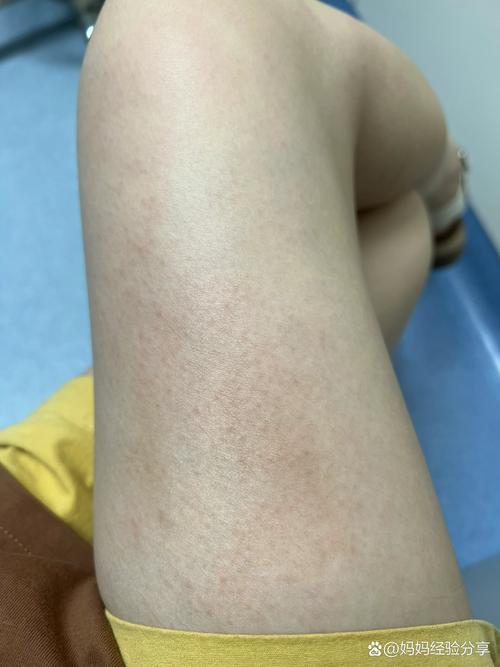 怀孕期间肚皮痒且有红点,是皮肤问题还是妊娠特殊反应?-第3张图片-郑州医学网 怀孕期间肚皮痒且有红点,是皮肤问题还是妊娠特殊反应?-第3张图片-郑州医学网