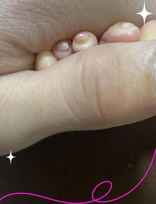 儿童指甲凹凸不平是缺钙还是生病？这些图片背后的健康信号你读懂了吗？-第1张图片-郑州医学网