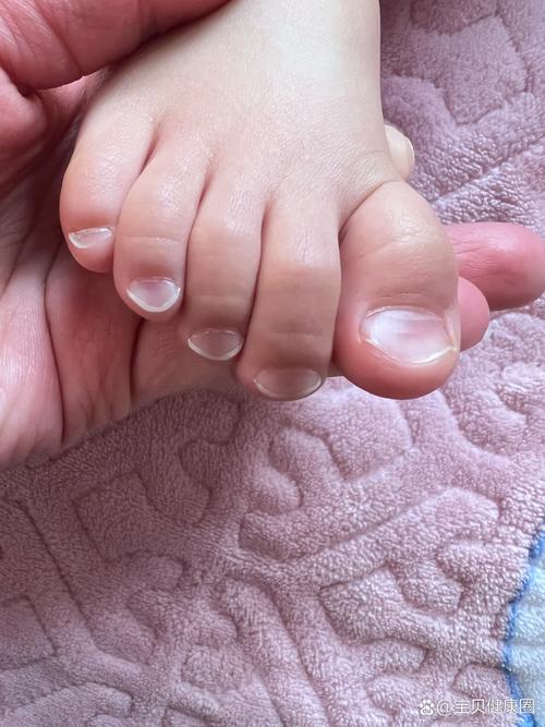 儿童指甲凹凸不平是缺钙还是生病？这些图片背后的健康信号你读懂了吗？-第2张图片-郑州医学网