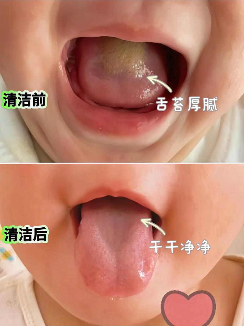 新生儿喝奶粉后舌头发白是正常现象还是健康问题?-第1张图片-郑州医学网 新生儿喝奶粉后舌头发白是正常现象还是健康问题?-第1张图片-郑州医学网