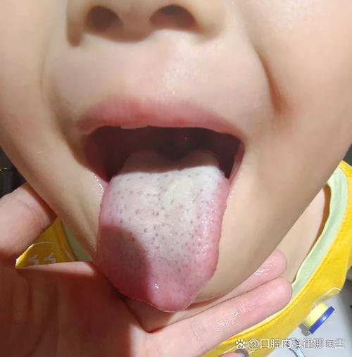 新生儿喝奶粉后舌头发白是正常现象还是健康问题？-第3张图片-郑州医学网
