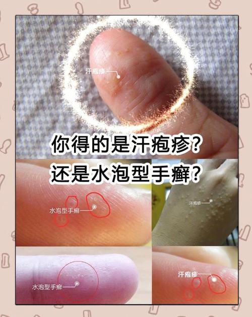 新生儿汗疱疹会自行消退吗？家长需要怎么护理才好？-第3张图片-郑州医学网