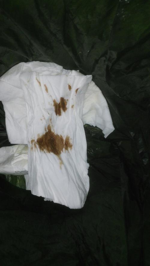 怀孕期间流出黑色粘稠物是先兆流产还是其他异常情况？-第1张图片-郑州医学网