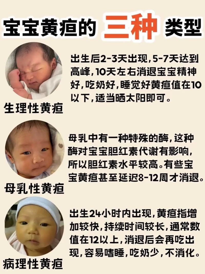 新生儿黄疸究竟分哪几种类型?不同类型又该如何区分与应对?-第1张图片-郑州医学网 新生儿黄疸究竟分哪几种类型?不同类型又该如何区分与应对?-第1张图片-郑州医学网