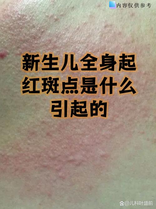 新生儿全身红多久能好?一般几天消退?需要就医吗?-第2张图片-郑州医学网 新生儿全身红多久能好?一般几天消退?需要就医吗?-第2张图片-郑州医学网