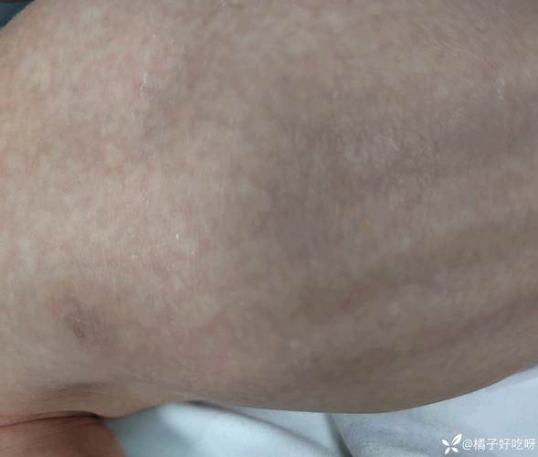 新生儿皮质增生症有哪些典型症状？如何早期识别与干预？-第1张图片-郑州医学网