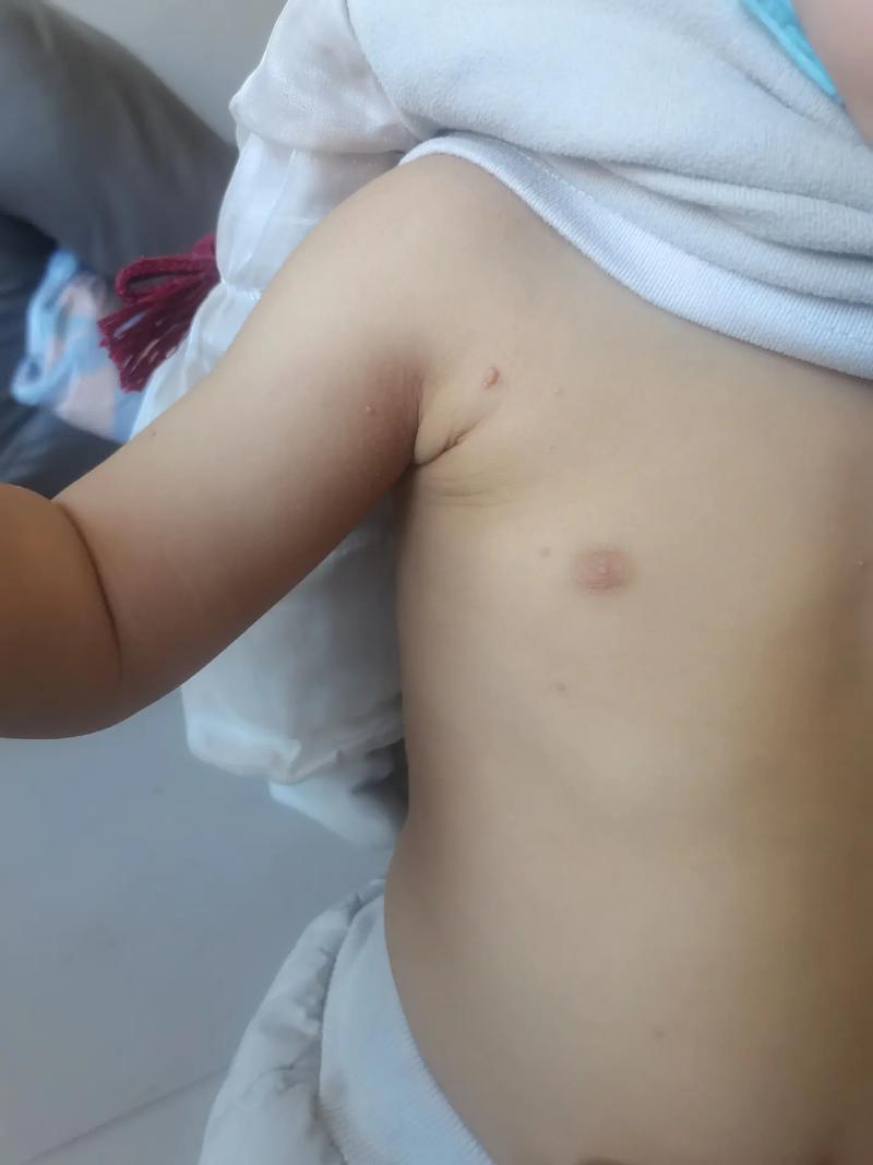 新生儿皮质增生症有哪些典型症状？如何早期识别与干预？-第3张图片-郑州医学网