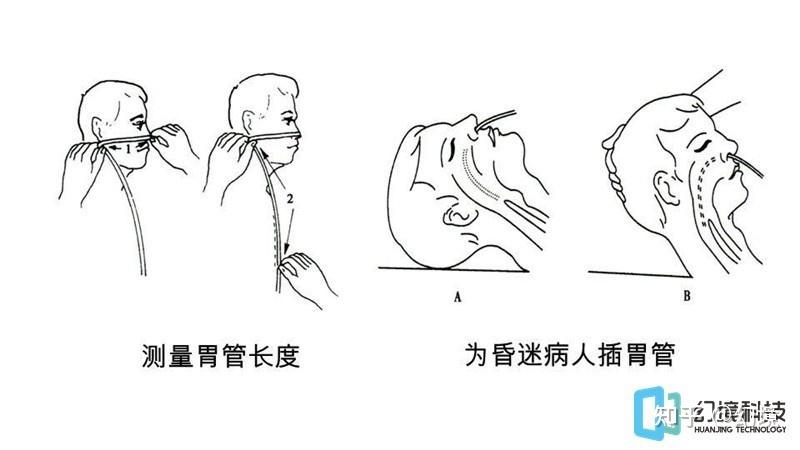 新生儿插胃管操作流程的关键步骤与注意事项有哪些？-第2张图片-郑州医学网