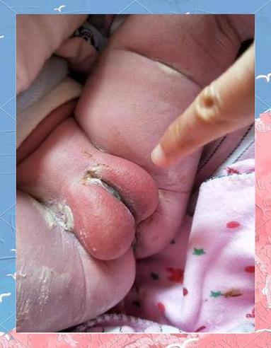 女新生儿私处发红图片是正常现象吗?需要就医处理吗?-第1张图片-郑州医学网 女新生儿私处发红图片是正常现象吗?需要就医处理吗?-第1张图片-郑州医学网