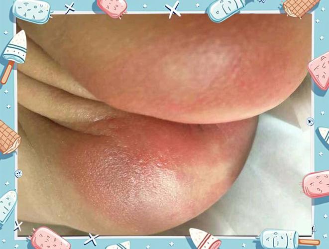 女新生儿私处发红图片是正常现象吗?需要就医处理吗?-第2张图片-郑州医学网 女新生儿私处发红图片是正常现象吗?需要就医处理吗?-第2张图片-郑州医学网