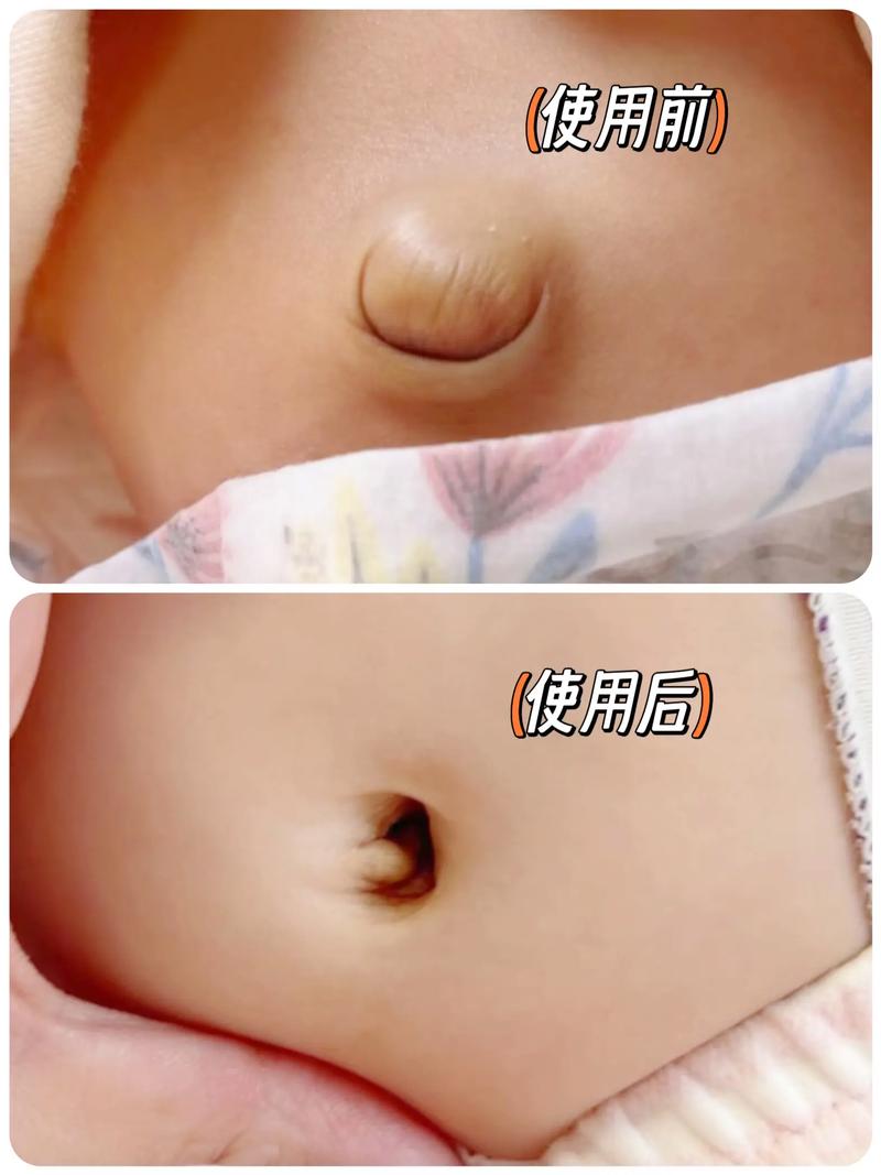 新生儿气肚脐是什么原因引起的？需要家长如何护理？-第2张图片-郑州医学网