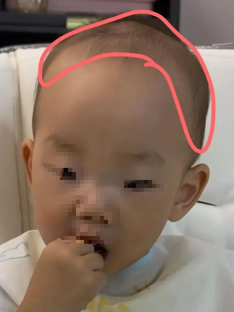 刚满月新生儿方颅是缺钙还是发育异常？需要干预吗？-第1张图片-郑州医学网