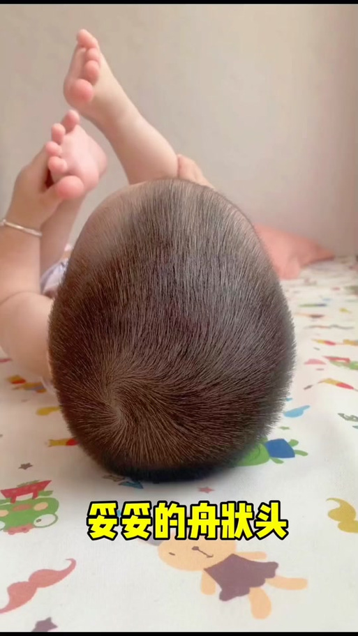 刚满月新生儿方颅是缺钙还是发育异常？需要干预吗？-第3张图片-郑州医学网