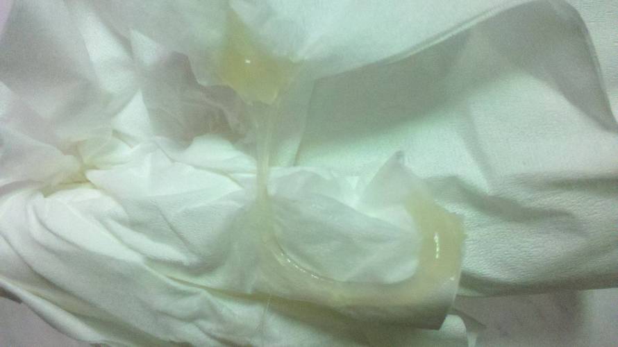 孕期出现水状分泌物是正常现象还是异常信号？需要警惕哪些潜在风险？-第1张图片-郑州医学网