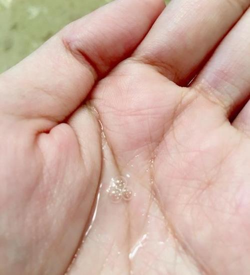 孕期出现水状分泌物是正常现象还是异常信号？需要警惕哪些潜在风险？-第3张图片-郑州医学网