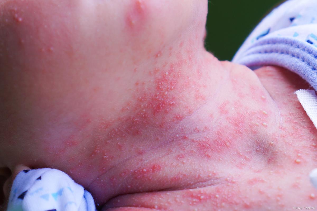 新生儿皮肤红得像小苹果，到底正常还是生病信号？-第1张图片-郑州医学网