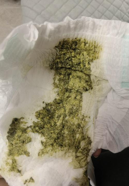 新生儿粑粑里有奶瓣是消化不良还是正常现象?-第3张图片-郑州医学网 新生儿粑粑里有奶瓣是消化不良还是正常现象?-第3张图片-郑州医学网