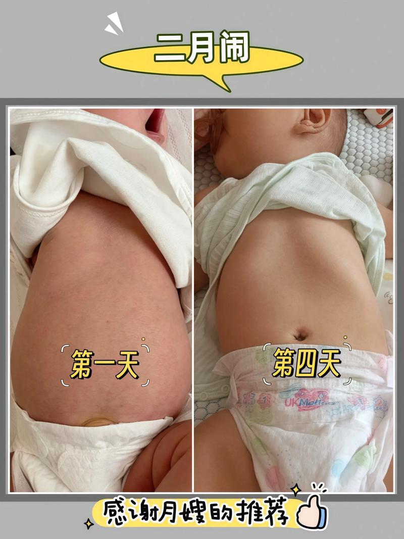 新生儿黄疸贴到底能不能用？有没有科学依据？-第3张图片-郑州医学网