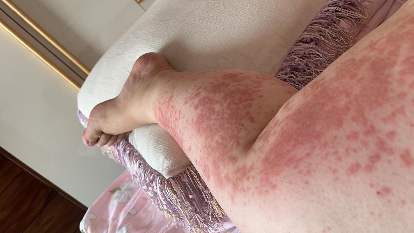 怀孕期间皮肤过敏图片-第2张图片-郑州医学网