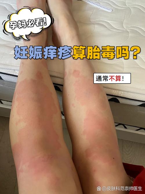 怀孕期间皮肤过敏图片-第1张图片-郑州医学网