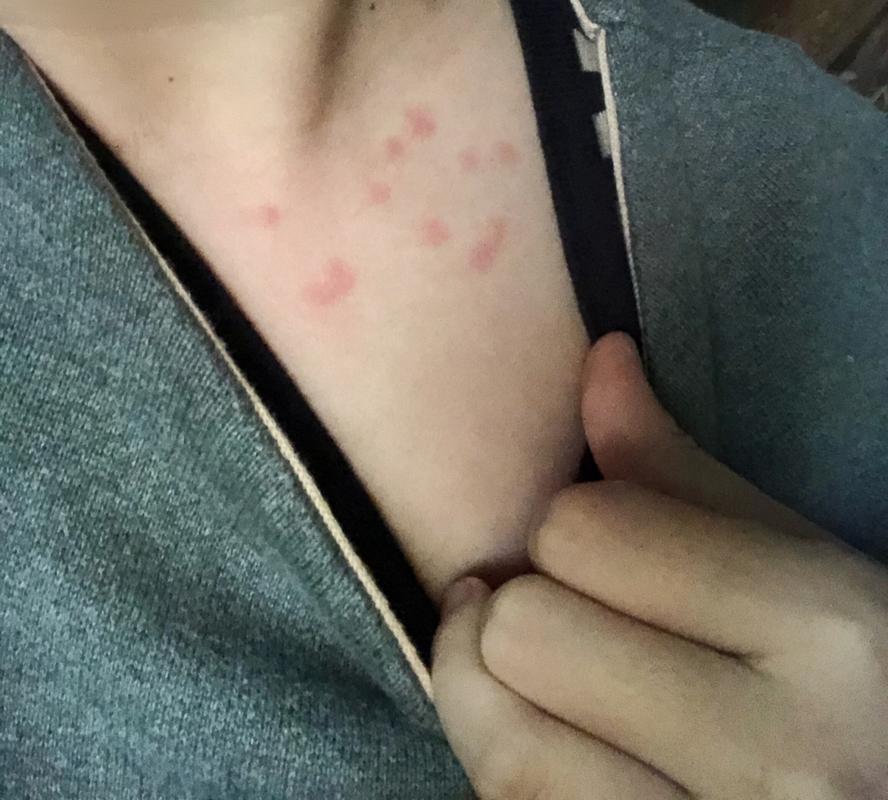 怀孕期间皮肤过敏图片-第3张图片-郑州医学网