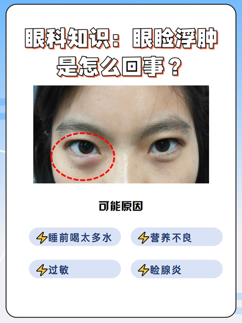 孕期眼睛莫名肿胀，是身体在传递什么危险信号吗？-第2张图片-郑州医学网